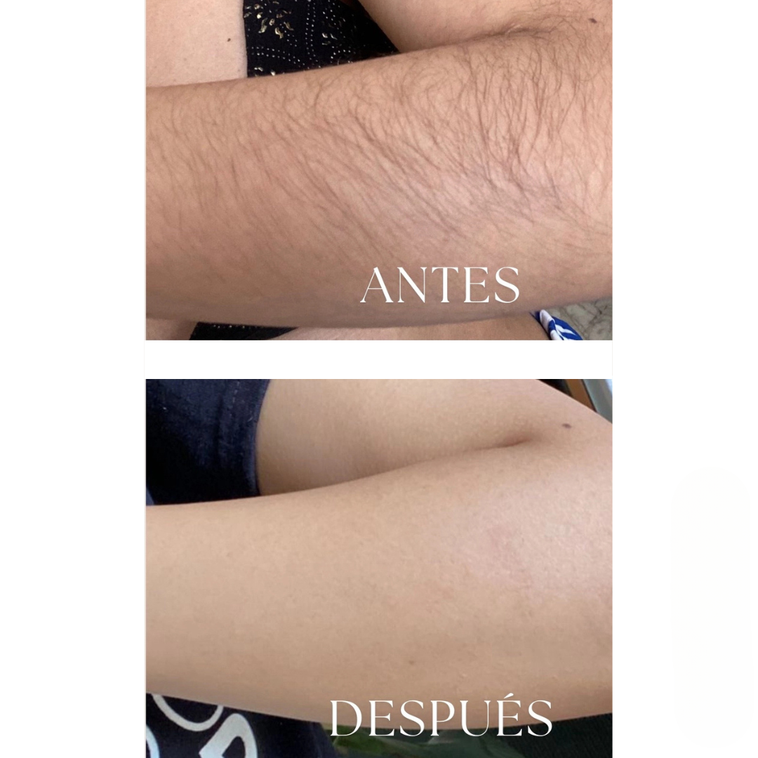 Silkvia – Depilación IPL Profesional desde Casa