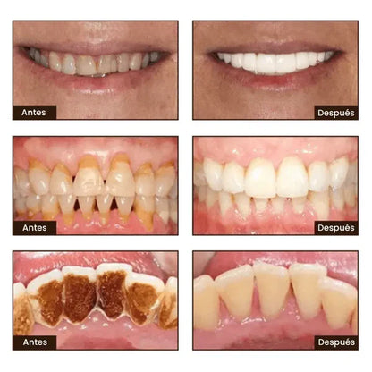 Blanqué – Blanqueamiento potente, sonrisa impecable